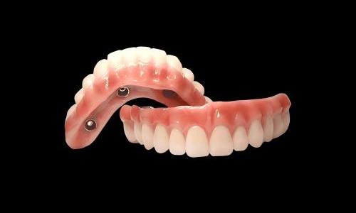 Everything You Need to Know About All-on-X Dental Implants (Complete Guide to Full-Mouth Restoration)